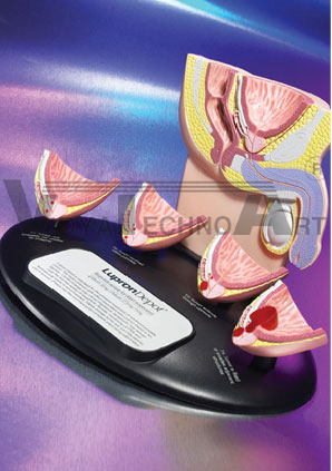 Four-Stage Prostate Cancer Model with Male Pelvic Anatomy